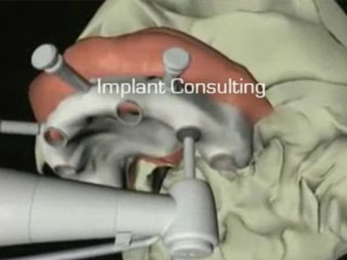 implant consulting